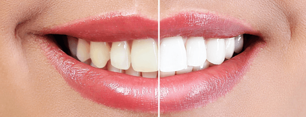 Teeth whitening