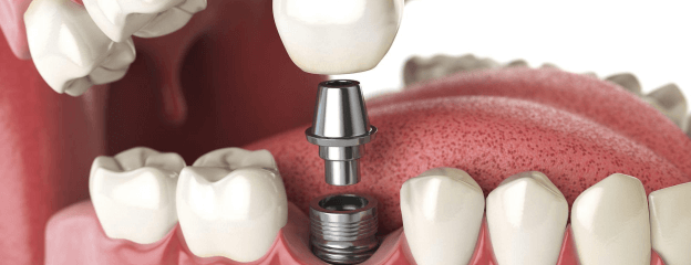 Implant Treatment