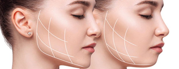 Masseter Botox Application